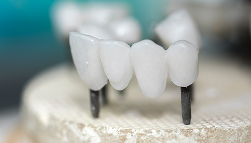 festsitzender Zahnersatz - Zahnarztpraxis Dr. Jaensch